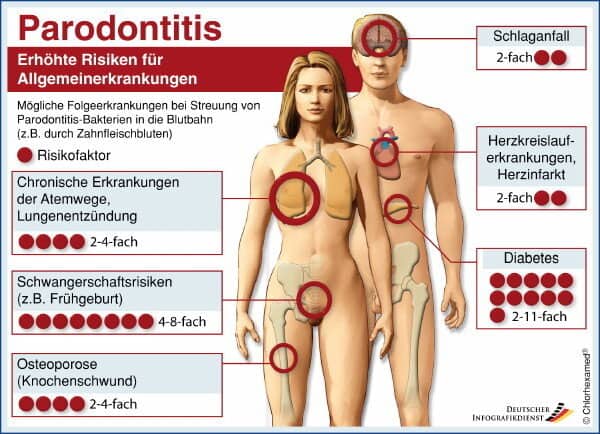 Parodontitis_gross